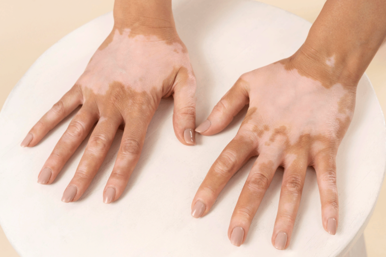 Vitiligo Nedir? Belirtileri ve Tedavi Yöntemleri - Hekimzade Blog